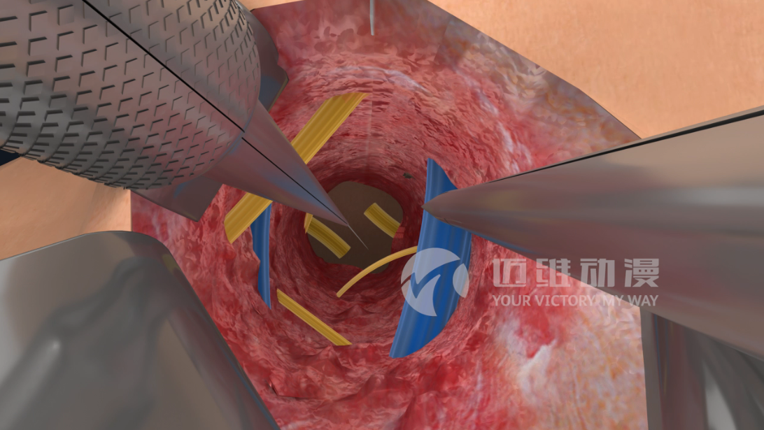 醫(yī)學(xué)手術(shù)三維動(dòng)畫(huà)